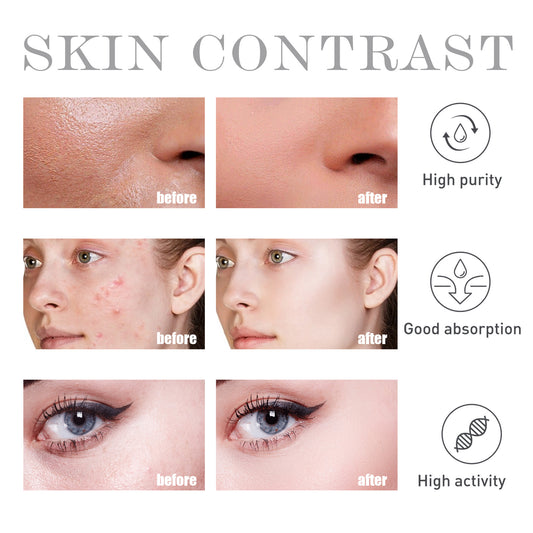 OUHOE Salicylate Acne & Blemish Control Water – Pore Purifying & Oil Balancing