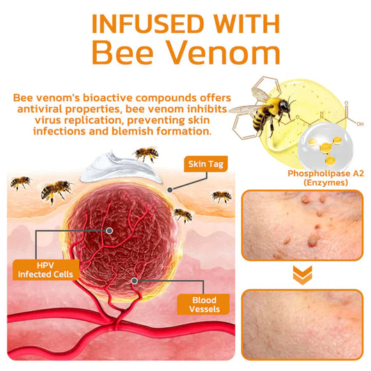 South Moon Bee Venom Wart & Mole Remover Cream – Painless, Scar-Free Support for All Skin Types