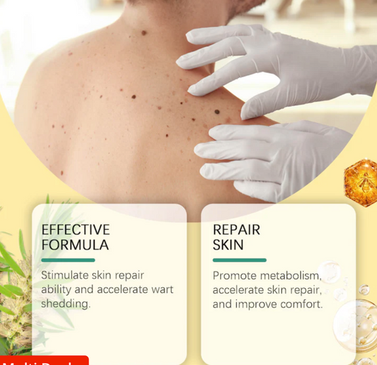 SOUTH MOON Bee Venom Wart Removal Support Spray – Gentle, Effective & Skin Repairing for All Warts (Genital & Body)