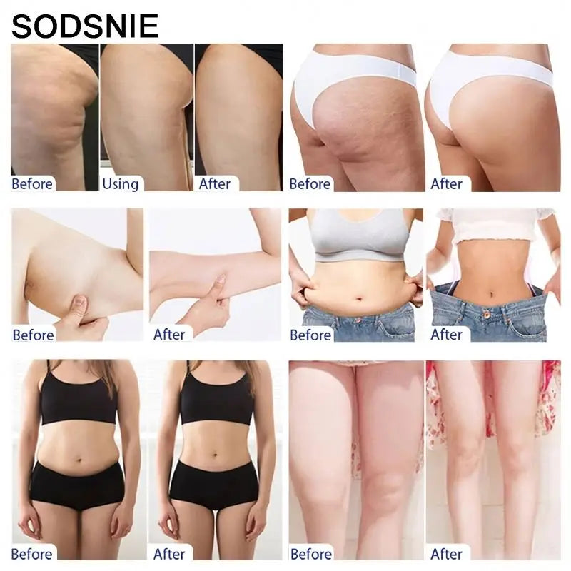 SODSNIE Fat Burning & Firming Cream – Cellulite Reduction & Body Shaping with Niacinamide