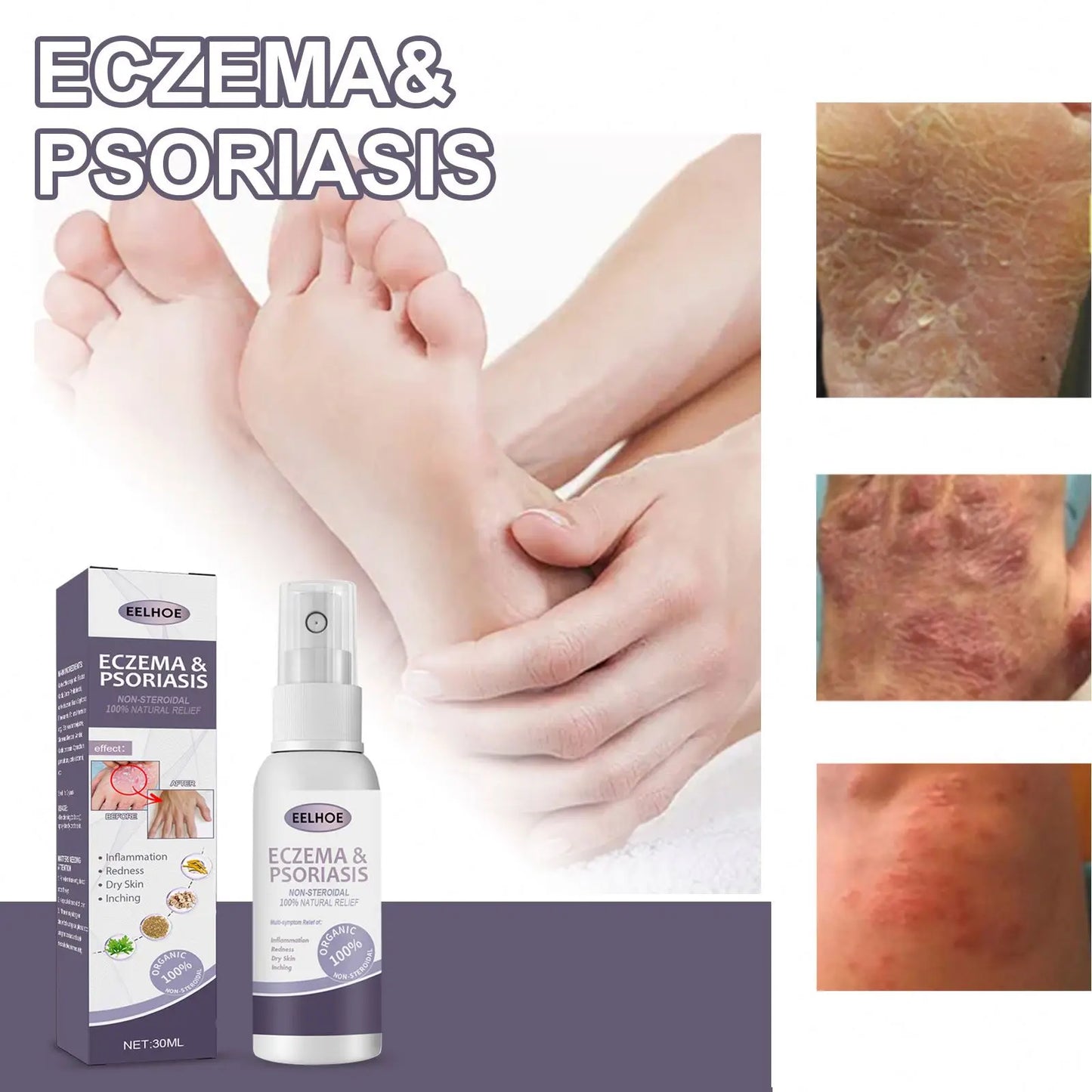 EELHOE Natural Eczema & Psoriasis Relief Spray – Fast-Acting Itch, Redness & Dryness Solution (50ml)