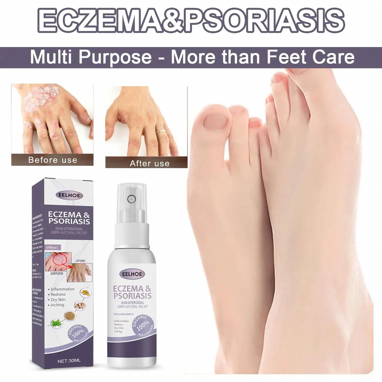 EELHOE Natural Eczema & Psoriasis Relief Spray – Fast-Acting Itch, Redness & Dryness Solution (50ml)
