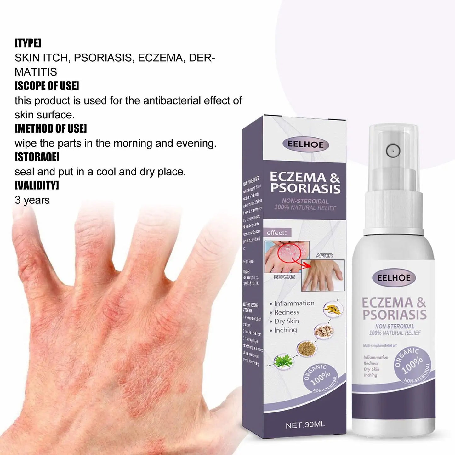 EELHOE Natural Eczema & Psoriasis Relief Spray – Fast-Acting Itch, Redness & Dryness Solution (50ml)