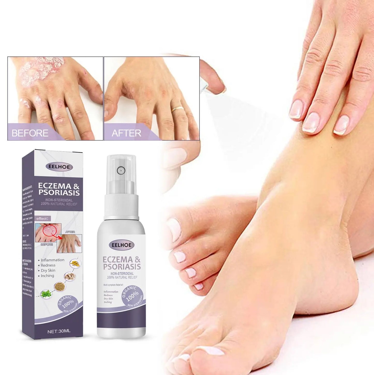 EELHOE Natural Eczema & Psoriasis Relief Spray – Fast-Acting Itch, Redness & Dryness Solution (50ml)