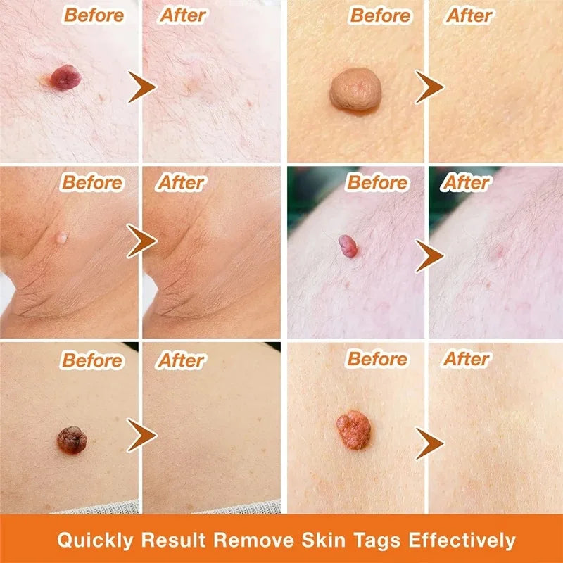 iBeaLee Precision Tag & Wart Remover Support – Natural Plant Extract Solution for All Skin (Genital & Body)