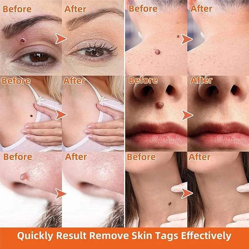 iBeaLee Precision Tag & Wart Remover Support – Natural Plant Extract Solution for All Skin (Genital & Body)