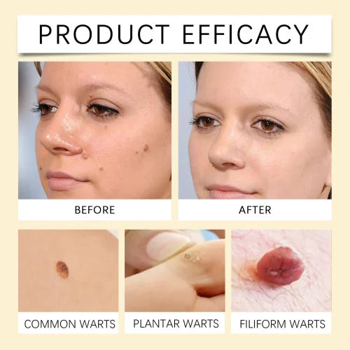 SOUTH MOON Multi-Benefit Skin Care Spray – Wart, Eczema & Psoriasis Relief with Bee Venom & Tea Tree Oil