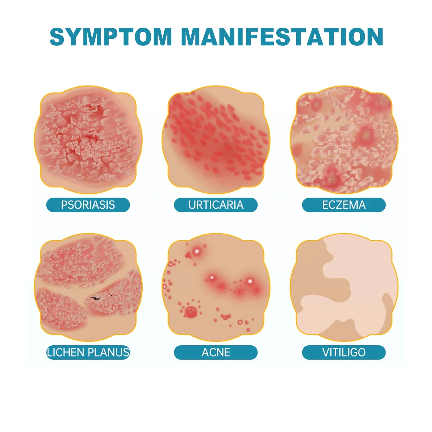 XIMONTH Herbal Eczema & Psoriasis Relief Spray – Fast-Acting Itch, Redness & Skin Repair (100ml)