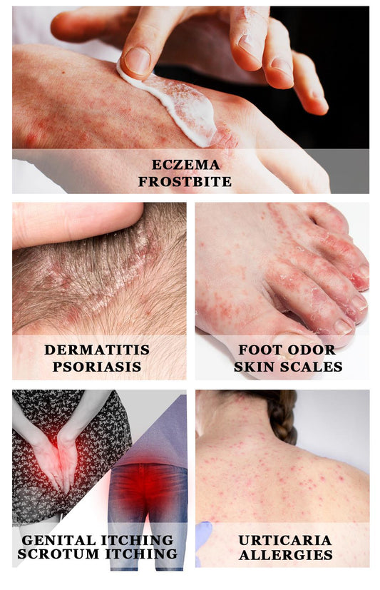 YOXIER Herbal Antibacterial Eczema, Psoriasis & Dermatitis Cream – Fast-Acting Itch, Redness & Peeling Relief (20G)