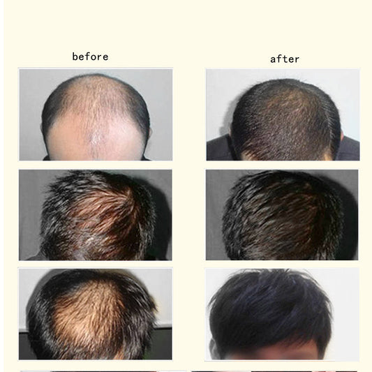 EELHOE Natural Essence Ginger Hair Care for Hair Loss - Restores Hair Follicles, Thicker Hair, 30ml - Buy 3, Pay for 2