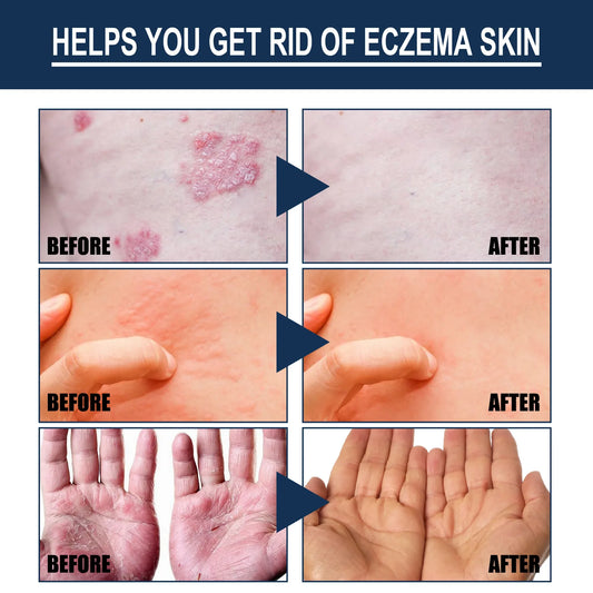 South Moon Calfskin Soothing Psoriasis Relief Spray – Effective Itch, Redness & Skin Repair (30ml)