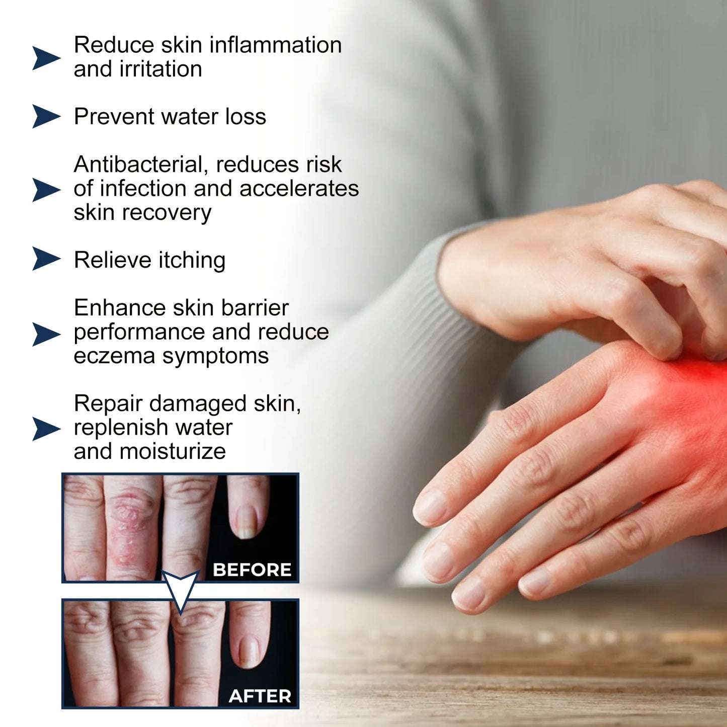 South Moon Calfskin Soothing Psoriasis Relief Spray – Effective Itch, Redness & Skin Repair (30ml)