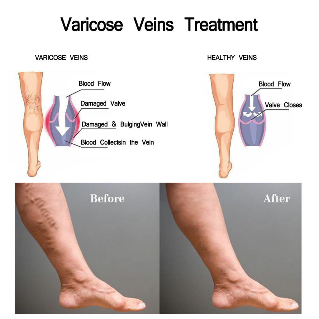 JAYSUNG Varicose Vein Cream – Advanced Relief for Leg Pain, Swelling & Spider Veins