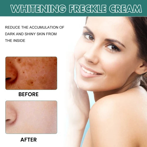 EELHOE Niacinamide Melasma Brightening Cream - Melanin Reducer, Brightening Dark Spot Remover, Freckle Remover, Firming, Fine Line Reducer, Chloasma Face Care - Firming & Anti-Aging Face