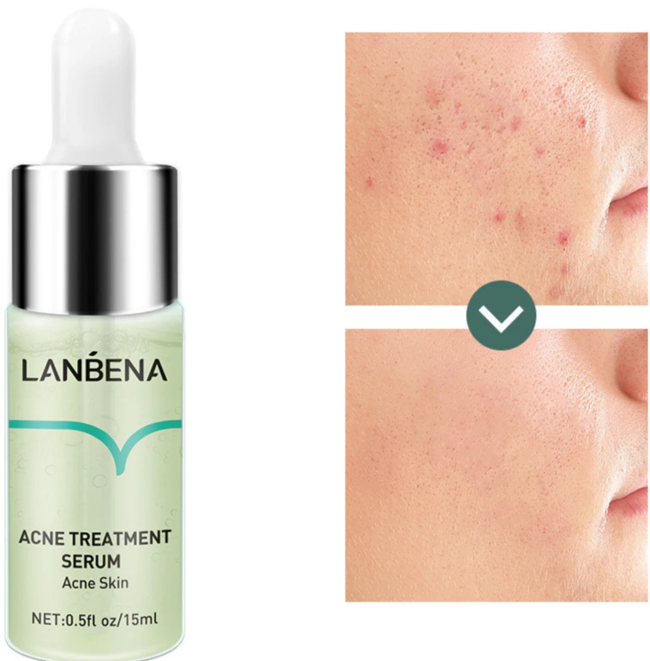 Acne & Pimples & Freckles & Blemishes