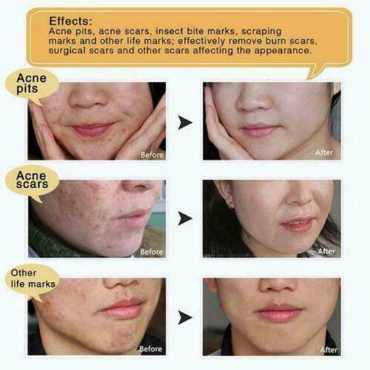 G.M. MEDIPHAR Acne and Scar Removal Original Vietnam Snake Ointment 5g - Buy 3 Pay for 2