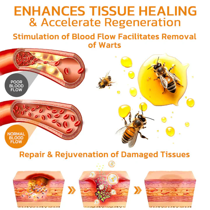 South Moon Bee Venom Wart & Mole Remover Cream – Painless, Scar-Free Support for All Skin Types