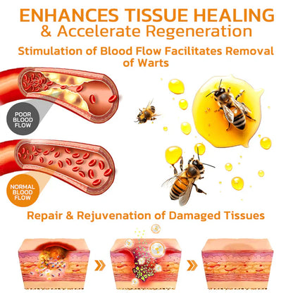 South Moon Bee Venom Wart & Mole Remover Cream – Painless, Scar-Free Support for All Skin Types