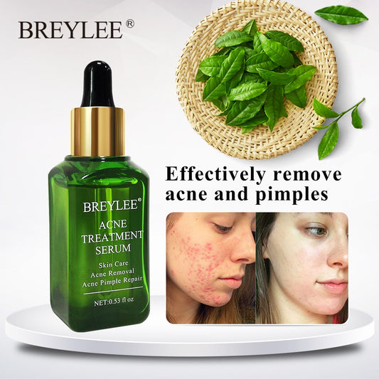 BREYLEE Acne Herbal Support Serum - Anti Acne Scar Removal Cream Skin Care Whitening Repair Acne Remover