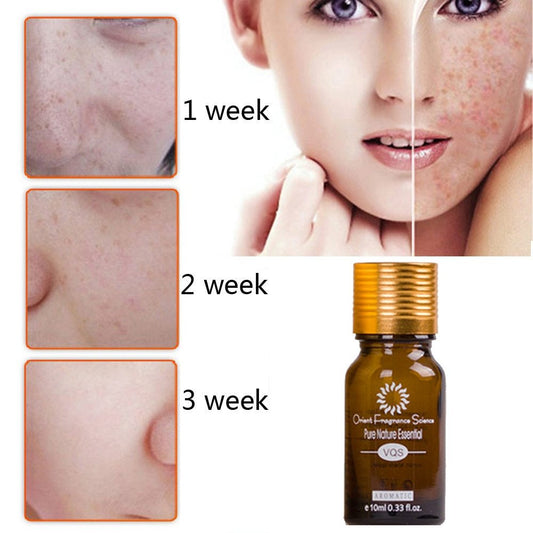 VQS Acne, Stretch Mark, and Scar Remover; Dark Spot and Hyperpigmentation Eliminator, Essence oil