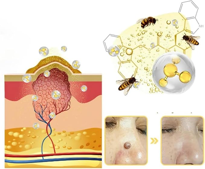 WEST MONTH Wart Removal Cream Professional Herbal Formula No Trace - Get Rid of Warts and Moles Without a Trace with Natural Formula