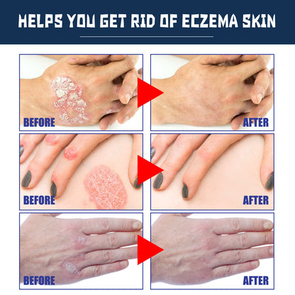 KENANLAN Psoriasis Relief Spray, Anti-Rash & Redness Herbal Support