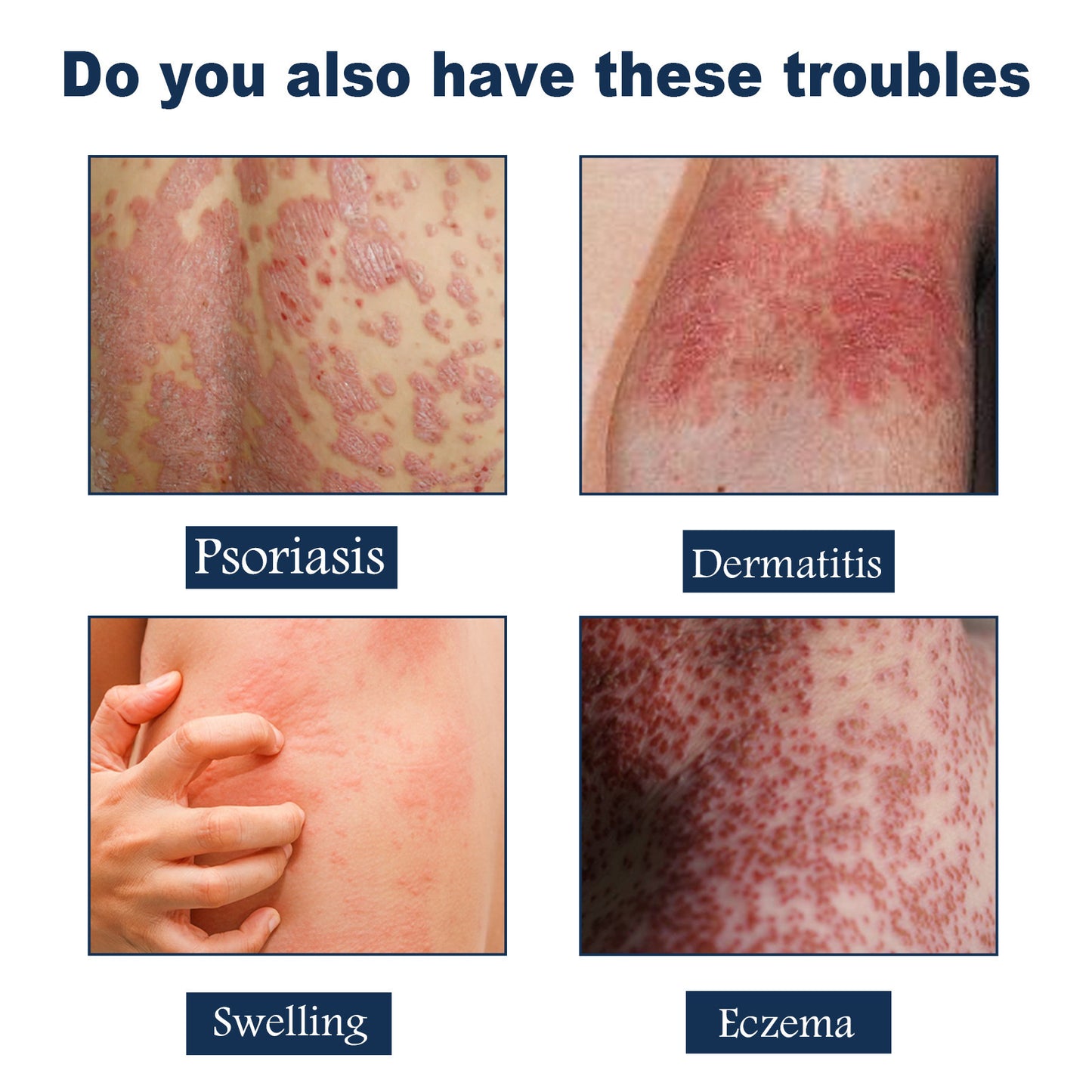 KENANLAN Psoriasis Relief Spray, Anti-Rash & Redness Herbal Support