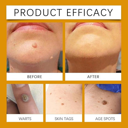 WEST MONTH Wart Removal Cream Professional Herbal Formula No Trace - Get Rid of Warts and Moles Without a Trace with Natural Formula