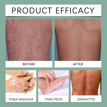 Ximonth Plant-Based Support for All Skin Concerns - Psoriasis, Eczema, Skin Allergies, Itching, and Rashes