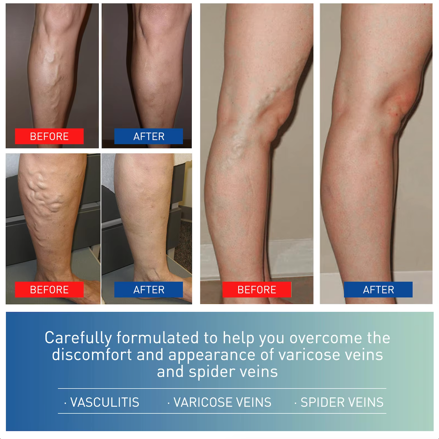 SOUTH MOON Varicose Vein and Leg Pain Relief Ointment, Phlebitis Soothing, Effective Support for Vasculitis, Worm and Spider Vein Appearance