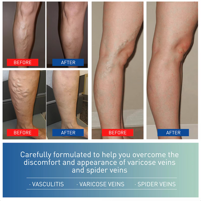 SOUTH MOON Varicose Vein and Leg Pain Relief Ointment, Phlebitis Soothing, Effective Support for Vasculitis, Worm and Spider Vein Appearance