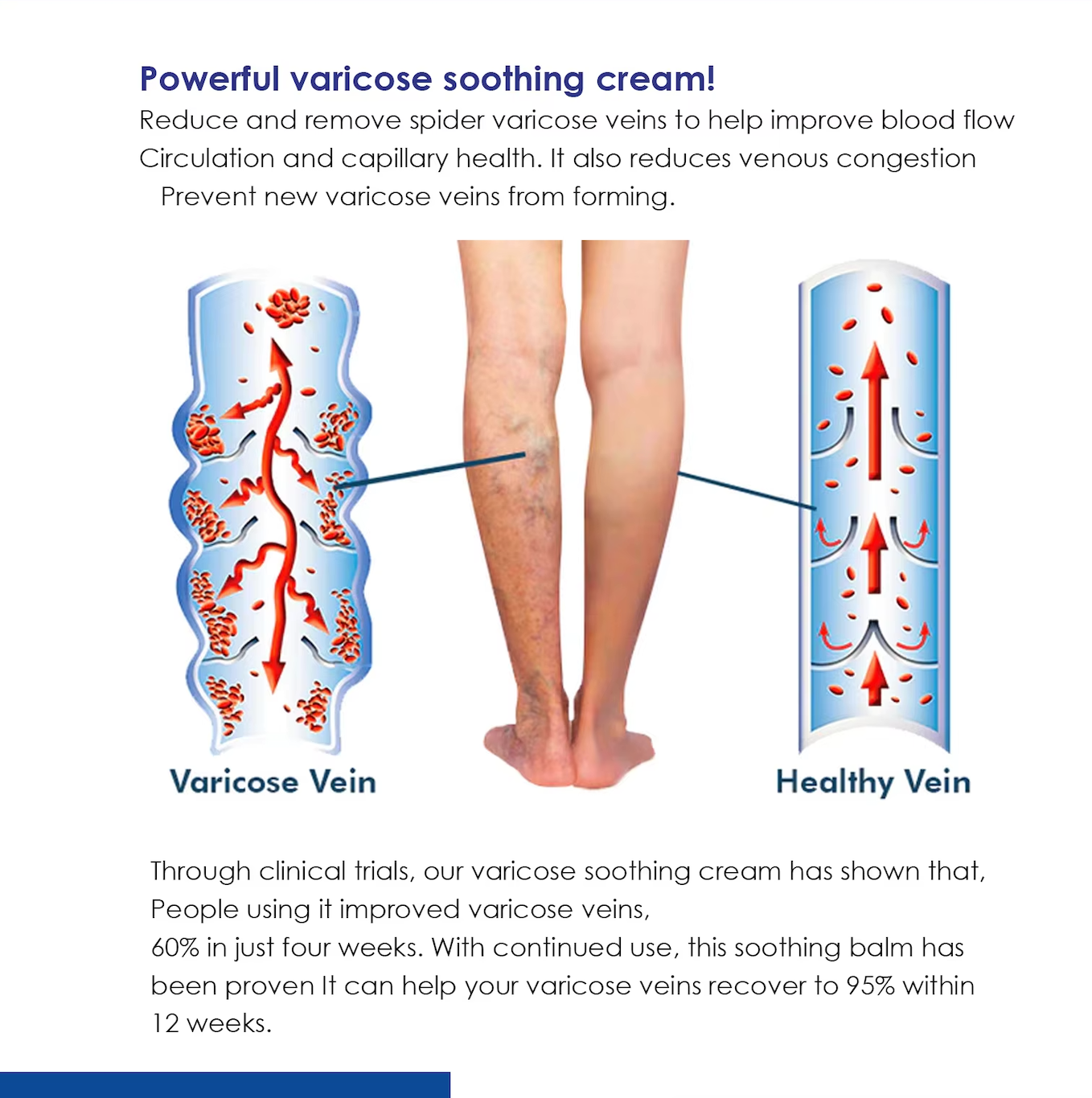 SOUTH MOON Varicose Vein and Leg Pain Relief Ointment, Phlebitis Soothing, Effective Support for Vasculitis, Worm and Spider Vein Appearance