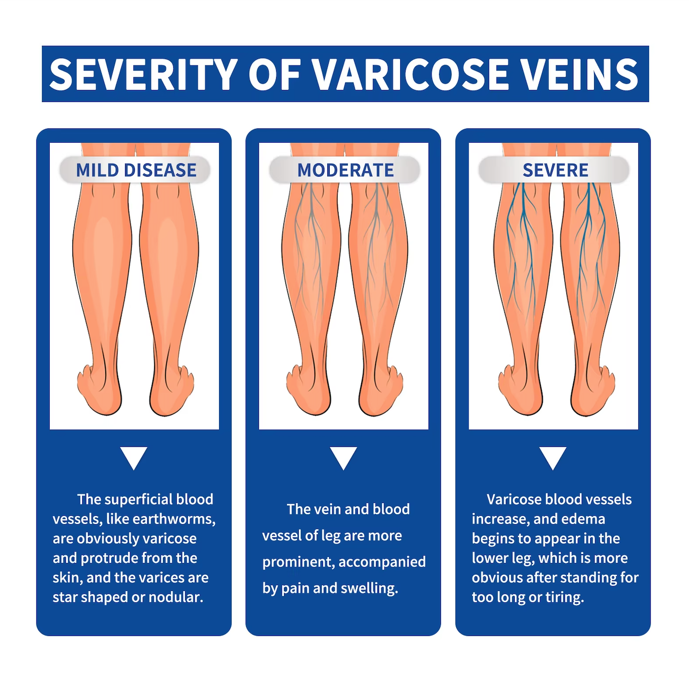 SOUTH MOON Varicose Vein and Leg Pain Relief Ointment, Phlebitis Soothing, Effective Support for Vasculitis, Worm and Spider Vein Appearance