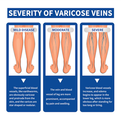 SOUTH MOON Varicose Vein and Leg Pain Relief Ointment, Phlebitis Soothing, Effective Support for Vasculitis, Worm and Spider Vein Appearance