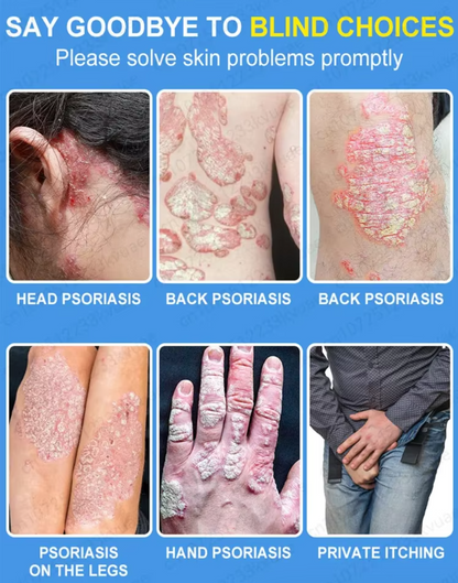POZANIS Psoriasis Support Cream – Say goodbye to itching, rejuvenate your skin, dryness, and ulcers, and restore skin vitality.