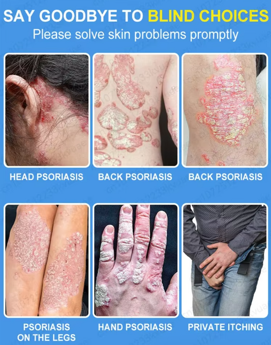 POZANIS Psoriasis Support Cream – Say goodbye to itching, rejuvenate your skin, dryness, and ulcers, and restore skin vitality.
