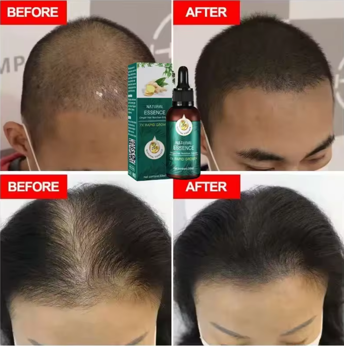 EELHOE Natural Essence Ginger Hair Care for Hair Loss - Restores Hair Follicles, Thicker Hair, 30ml - Buy 3, Pay for 2