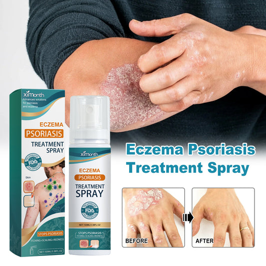 XIMONTH Herbal Eczema & Psoriasis Relief Spray – Fast-Acting Itch, Redness & Skin Repair (100ml)