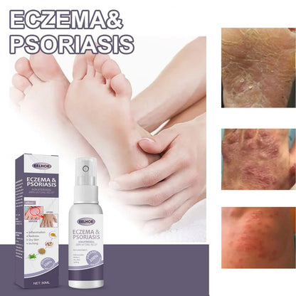 EELHOE Natural Eczema & Psoriasis Relief Spray – Fast-Acting Itch, Redness & Dryness Solution (50ml)
