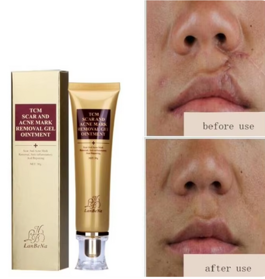 TCM Acne, Stretch Mark and Scar Remover, Pore Minimizer, Whitening Ginseng Acne Suppo Cream