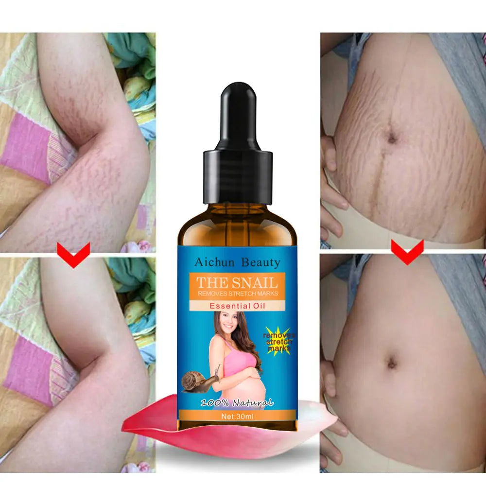 AICHUN BEAUTY Snail Belly Massage Oil (30ml) – Postpartum Skin Toning & Stretch Mark Appearance