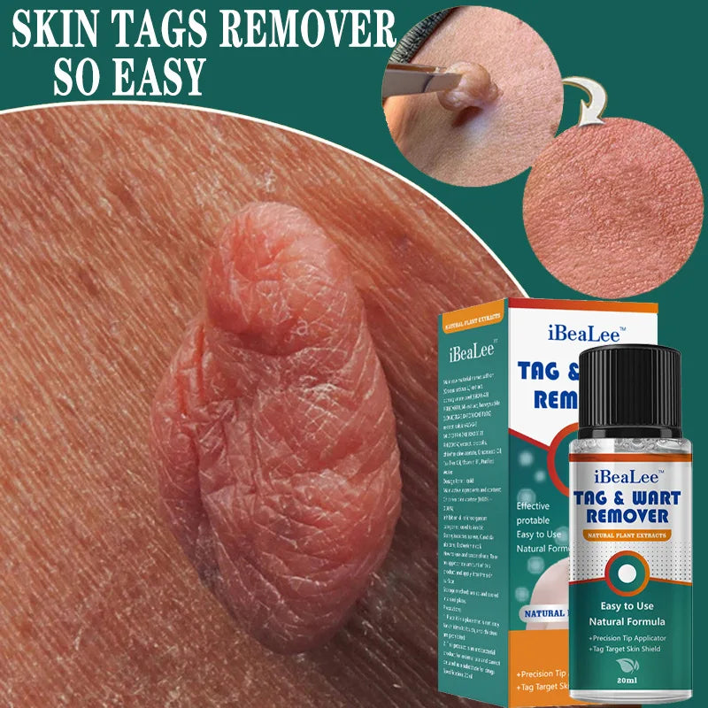 iBeaLee Precision Tag & Wart Remover Support – Natural Plant Extract Solution for All Skin (Genital & Body)