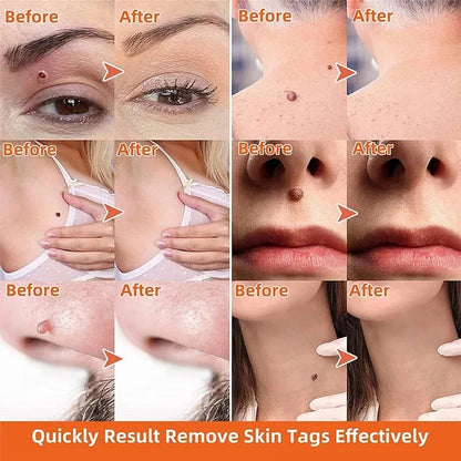iBeaLee Precision Tag & Wart Remover Support – Natural Plant Extract Solution for All Skin (Genital & Body)