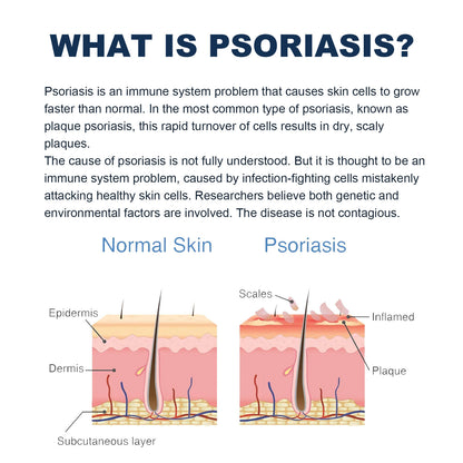 KENANLAN Psoriasis Relief Spray, Anti-Rash & Redness Herbal Support