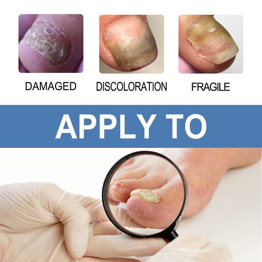 OUHOE Nail Fungus Remover Nail Care Cream - Get Healthy and Strong Nails with an Effective Formula!