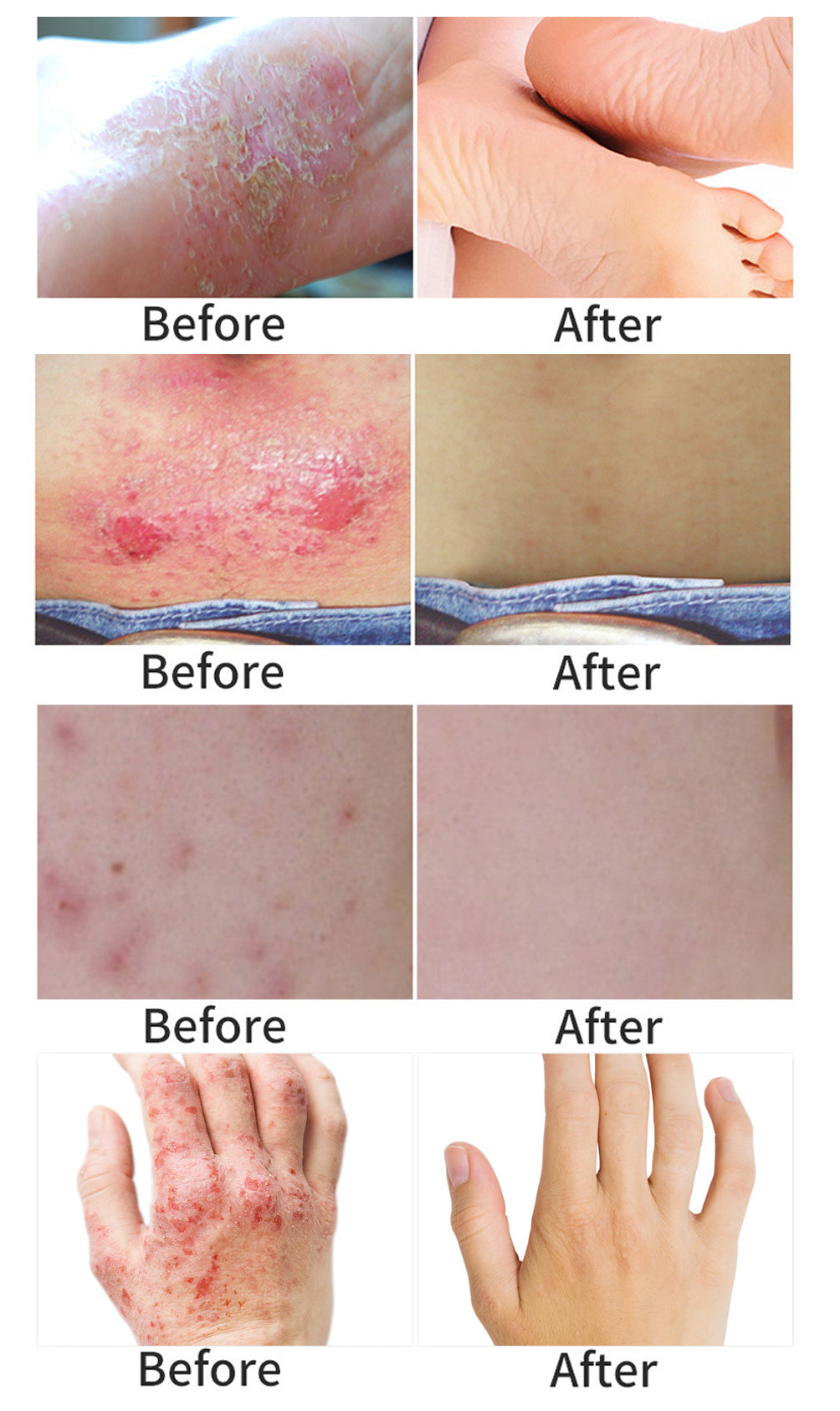 YOXIER Herbal Antibacterial Eczema, Psoriasis & Dermatitis Cream – Fast-Acting Itch, Redness & Peeling Relief (20G)