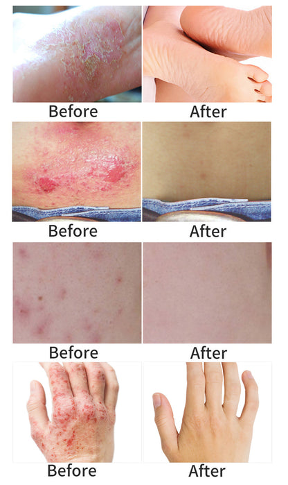 YOXIER Herbal Antibacterial Eczema, Psoriasis & Dermatitis Cream – Fast-Acting Itch, Redness & Peeling Relief (20G)
