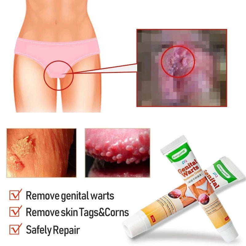KanyeHB Bee Venom Wart & Skin Tag Removal Cream – Genital & Body Warts Treatment
