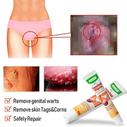 KanyeHB Bee Venom Wart & Skin Tag Removal Cream – Genital & Body Warts Treatment