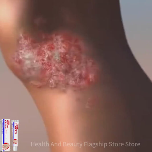 POZANIS Psoriasis Support Cream – Say goodbye to itching, rejuvenate your skin, dryness, and ulcers, and restore skin vitality.